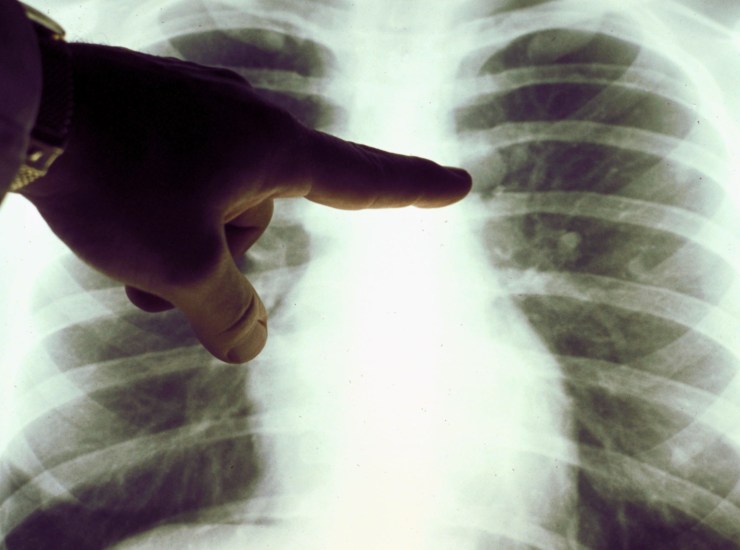 Tumore polmonare, nuovo farmaco riduce dell'80% rischio morte o recidiva