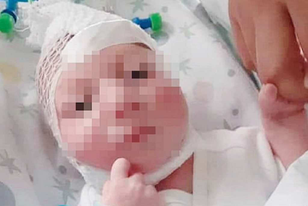 Il miracolo del bambino nato con due teste: ora parla e cammina